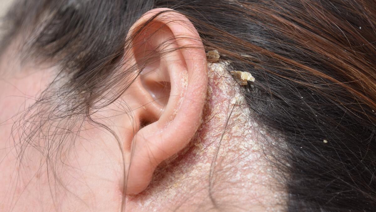 Seborrheic Eczema In Ear