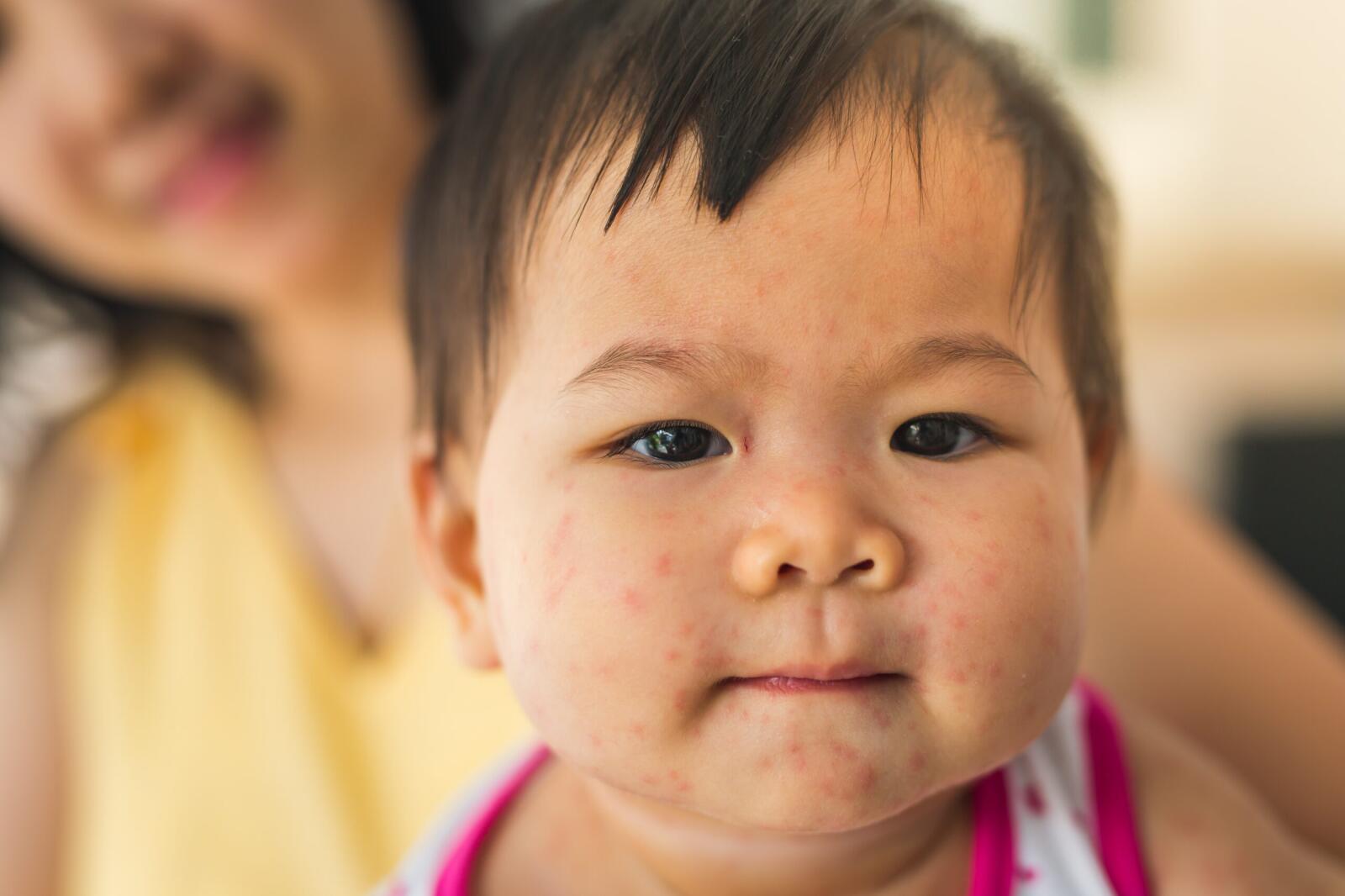 Roseola Causes, Symptoms, and Treatment