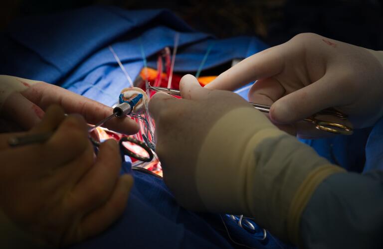 aortic-valve-replacement-surgery