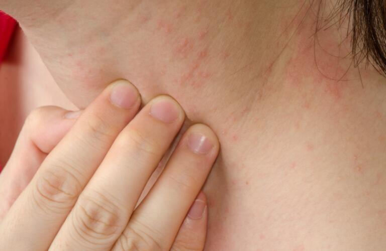 Hives on Neck