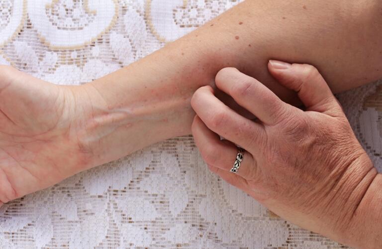 itchy-skin-rash