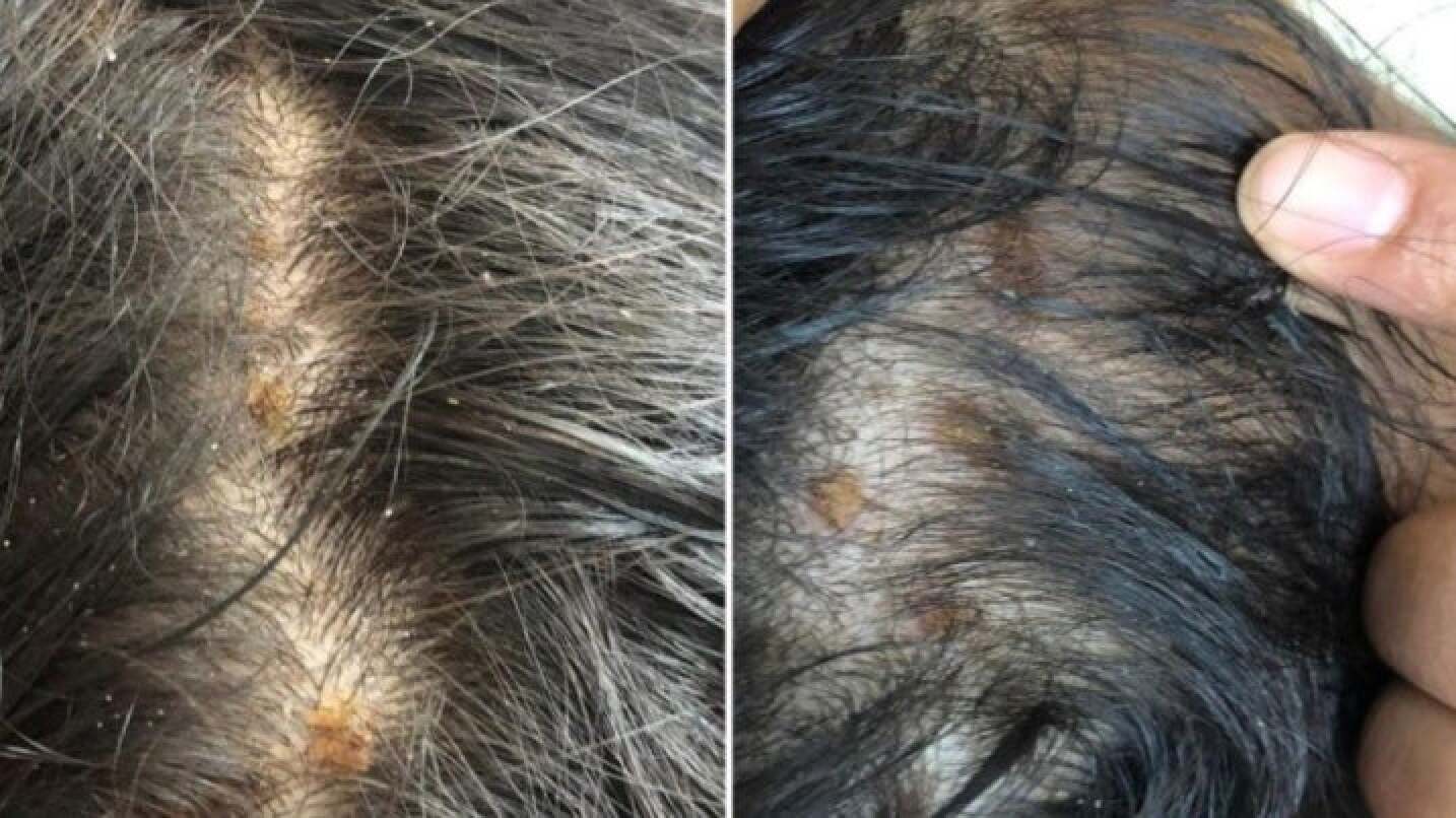 Dandruff vs. Dry Scalp Causes, Treatment, and Main Differences