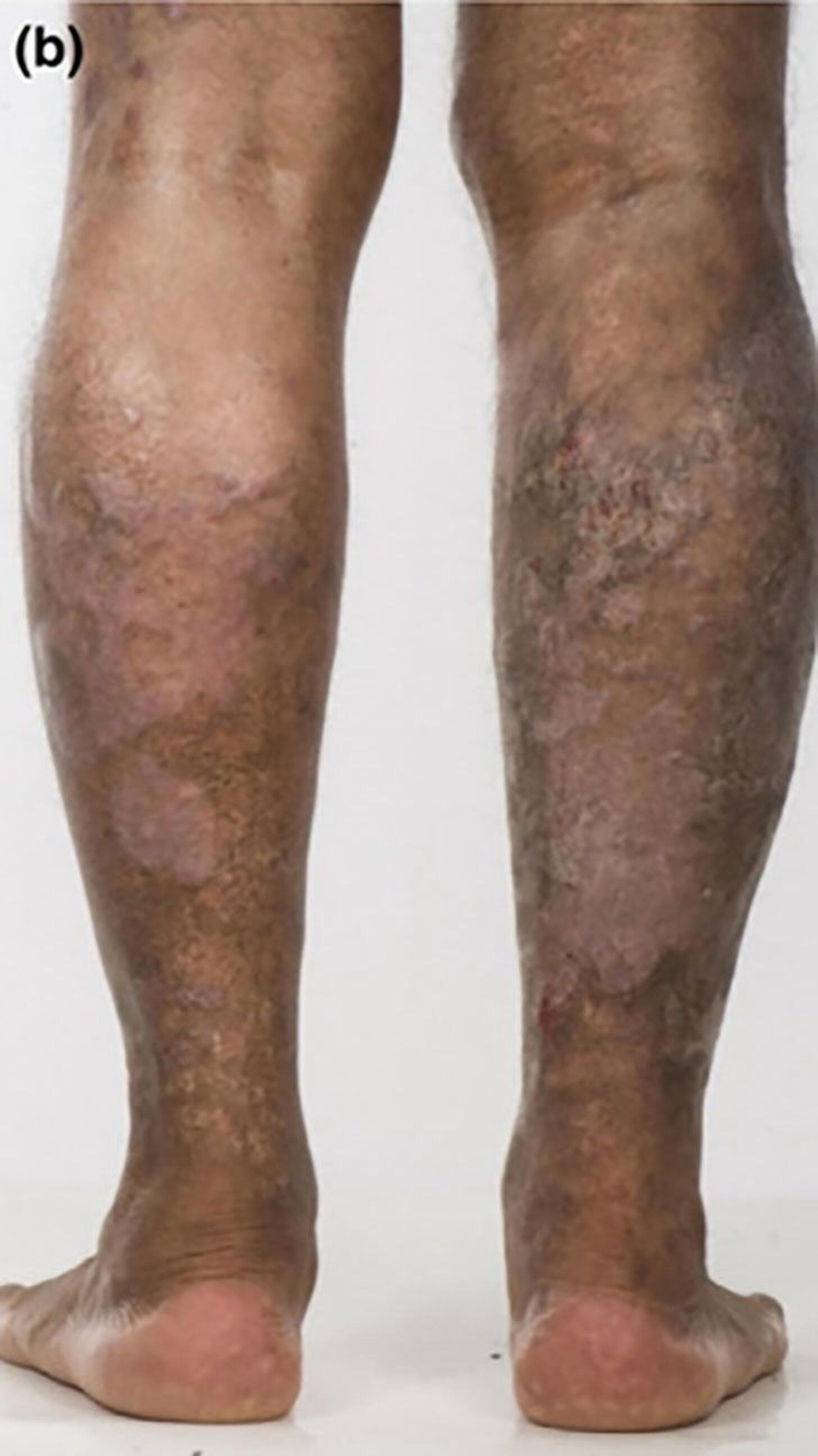 Ulcerative Colitis Rashes: Skin Conditions, Symptoms, Treatment