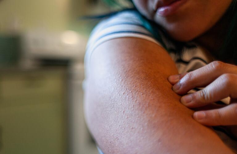 Beautiful Woman with Eczema Skin Condition on Arms