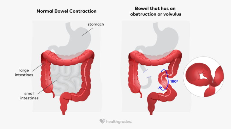 Illustration of a normal large intestine (large bowel) next to a large intestine with a sigmoid volvulus