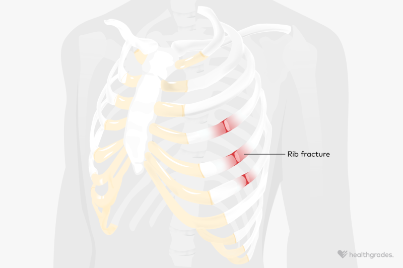 Rib Fracture: Symptoms, Diagnosis, and Treatments for a Broken Rib