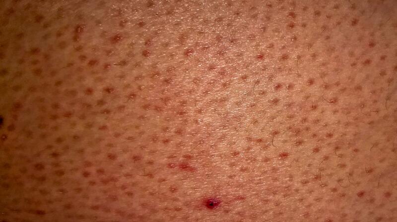 Keratosis Pilaris: Symptoms, Causes, and Treatment