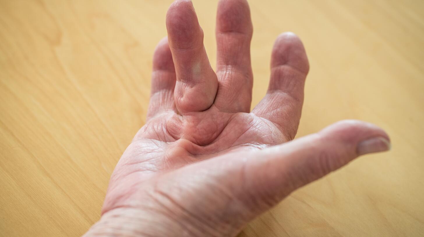 dupuytren's contracture of ring finger of woman's palm.