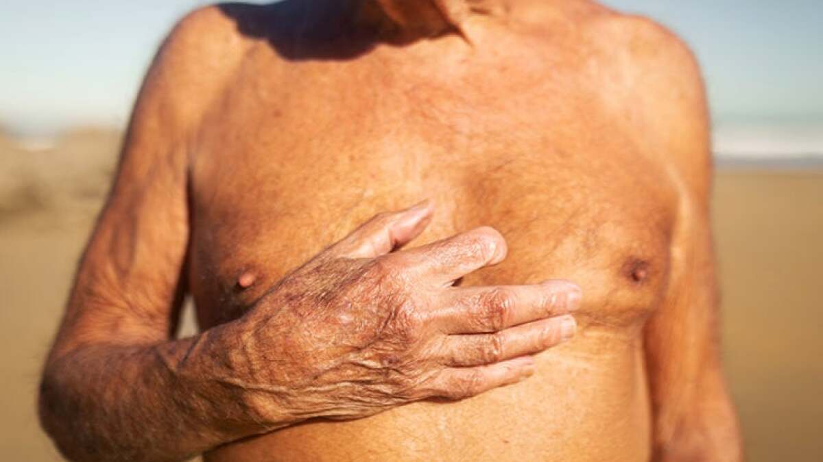 Cyst on Man's Chest Was Stage 3 Breast Cancer