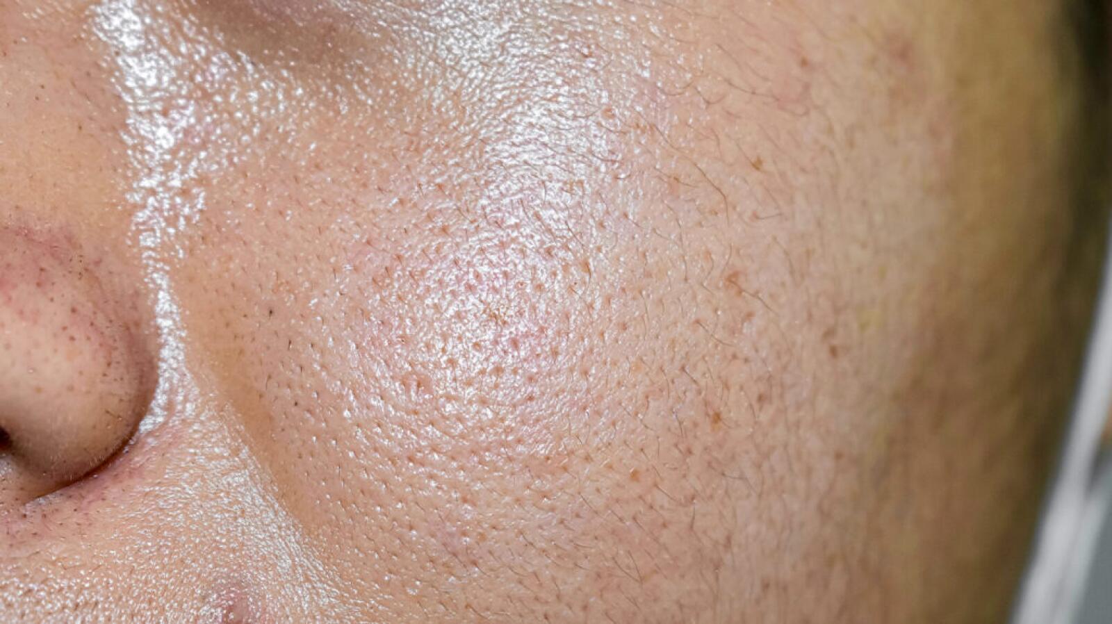Sebum What It Is, What It Does, Balancing Production, and More