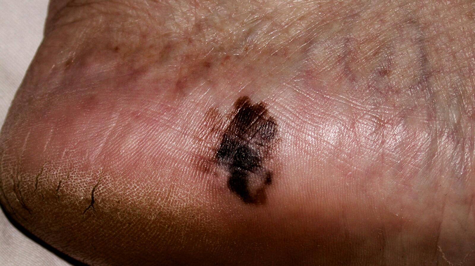 Acral Lentiginous Melanoma Causes Symptoms And Treatments acral-lentiginous-melanoma-causes-symptoms-and-treatments