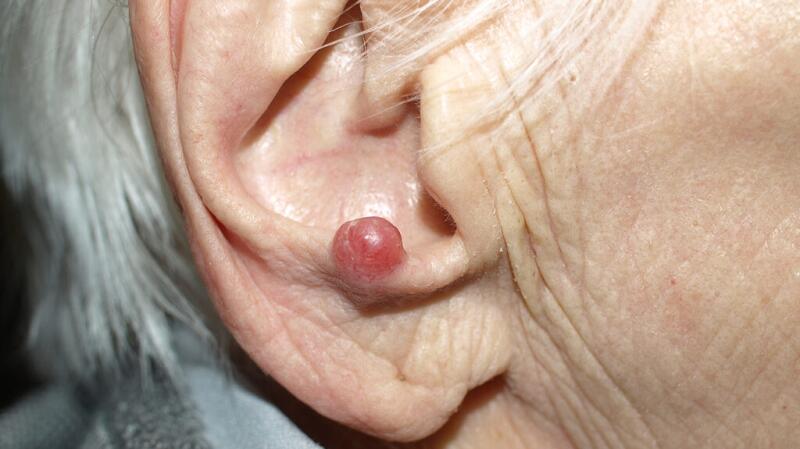 A red, dome-shaped merkel cell carcinoma growth.