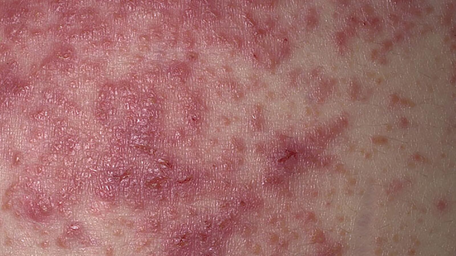 Dermatitis Herpetiformis (Gluten Rash): Everything to Know