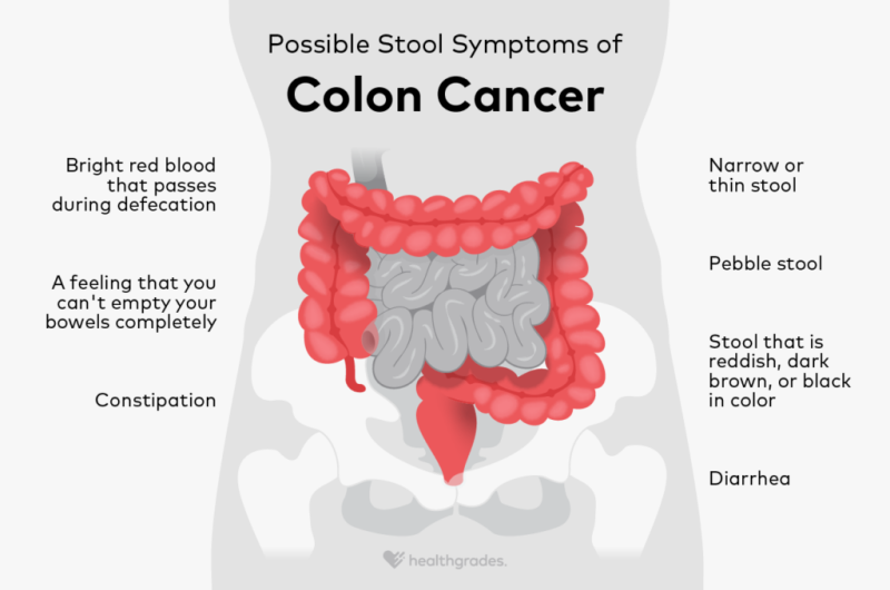 colon cancer stool pictures