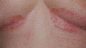 A medical image of inverse psoriasis.