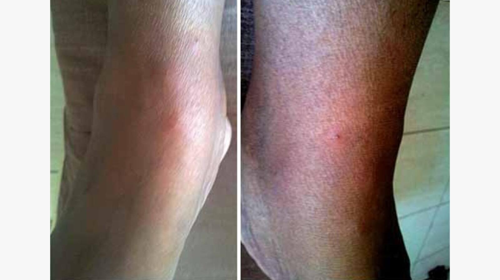 Fire Ant Bites: Symptoms, Remedies, Treatment, and More