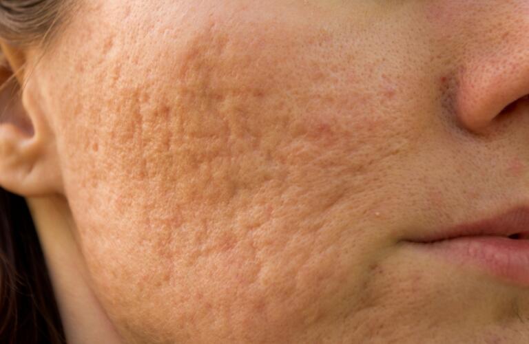 Acne Scars