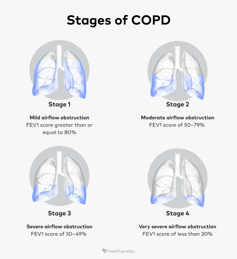 COPD Stages: Symptoms, Treatments, and More