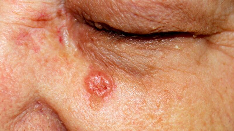 A swollen basal cell carcinoma lesion.
