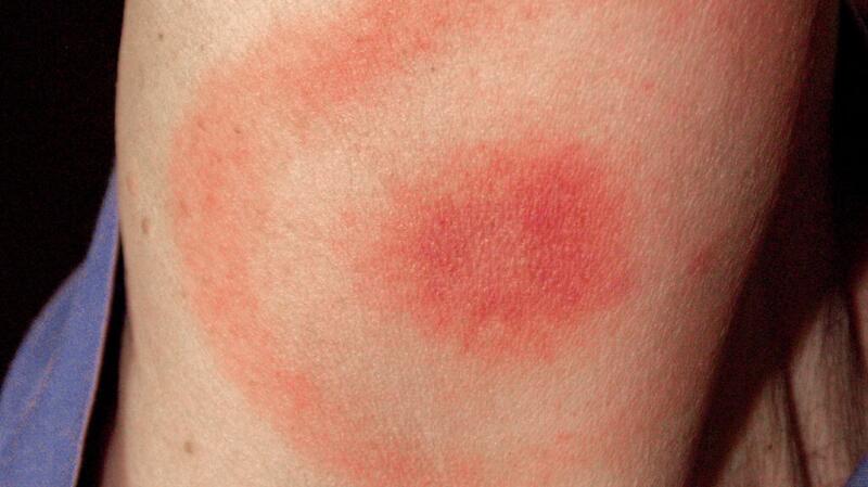Close-up of bull's-eye rash