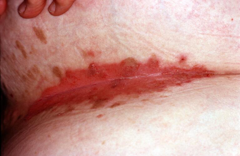 photo of inverse psoriasis