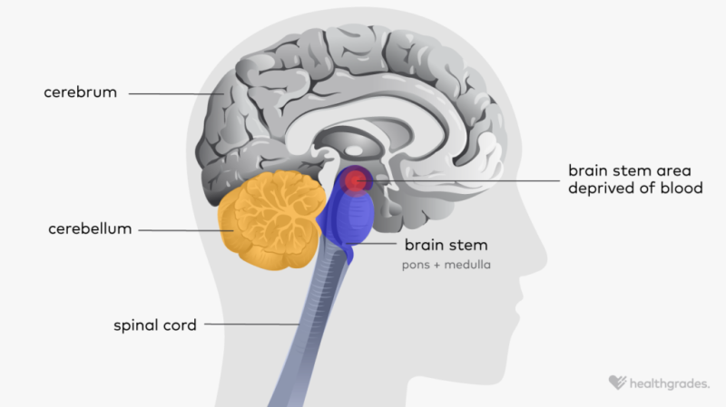 Brain Stem Stroke: Symptoms, Causes, Treatments, Recovery