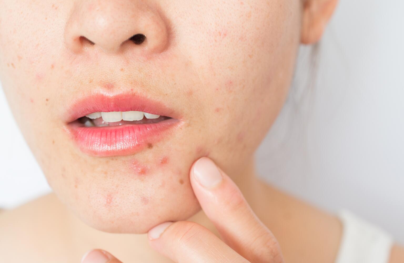 Boil vs. Pimple How to Tell the Difference