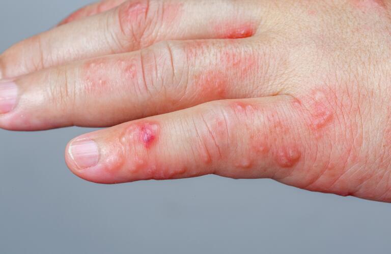 shingles (herpes zoster) rash and blisters on hand 