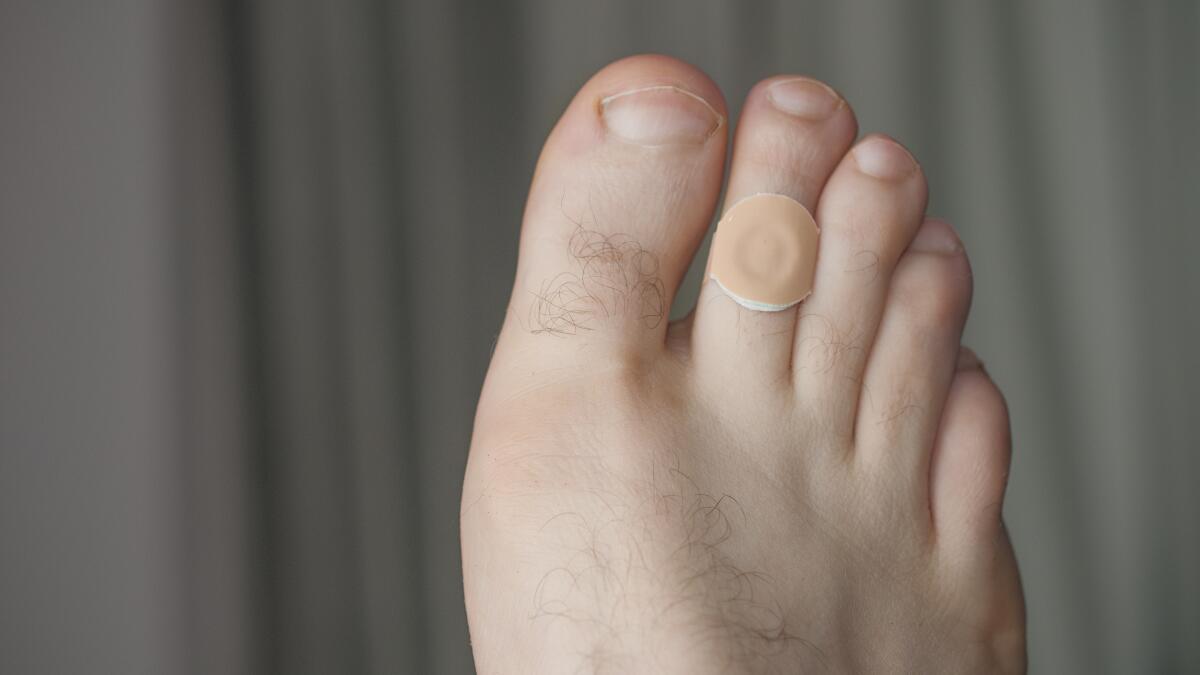 Tip of Toe Callus Removal by Podiatrist - Callus on the tip of the toe
