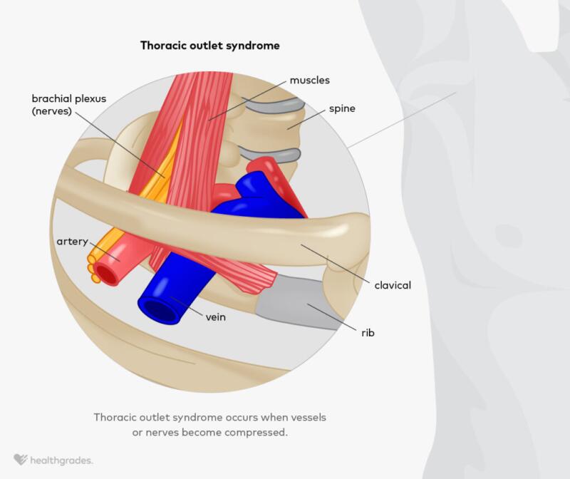 illustration of thoracic outlet syndrome under the shoulder, displaying the brachial plexus bundle of nerves, muscles, blood vessels, rib, and clavical