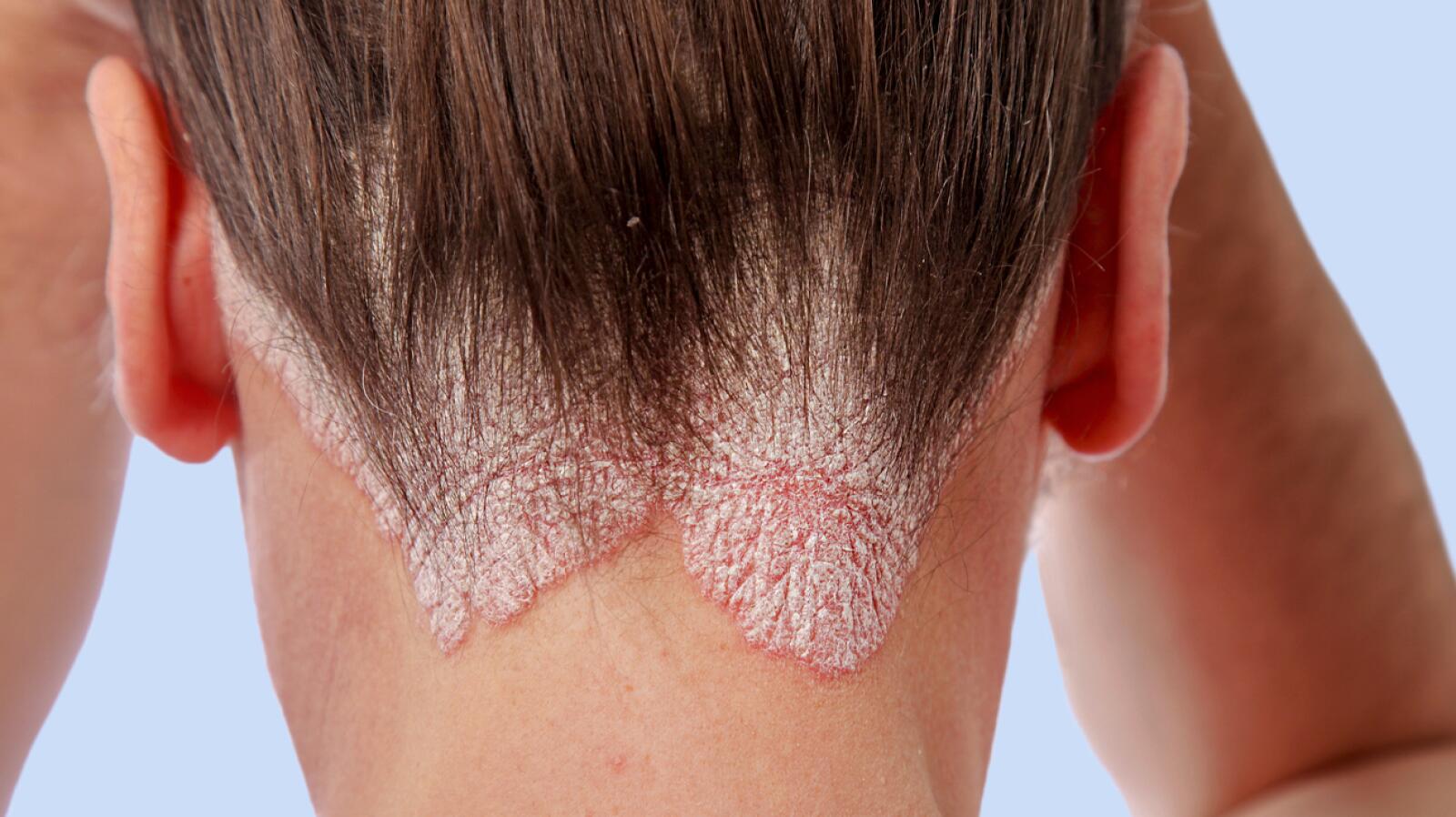 Scalp Psoriasis Vs Dandruff Comparison And Treatment 