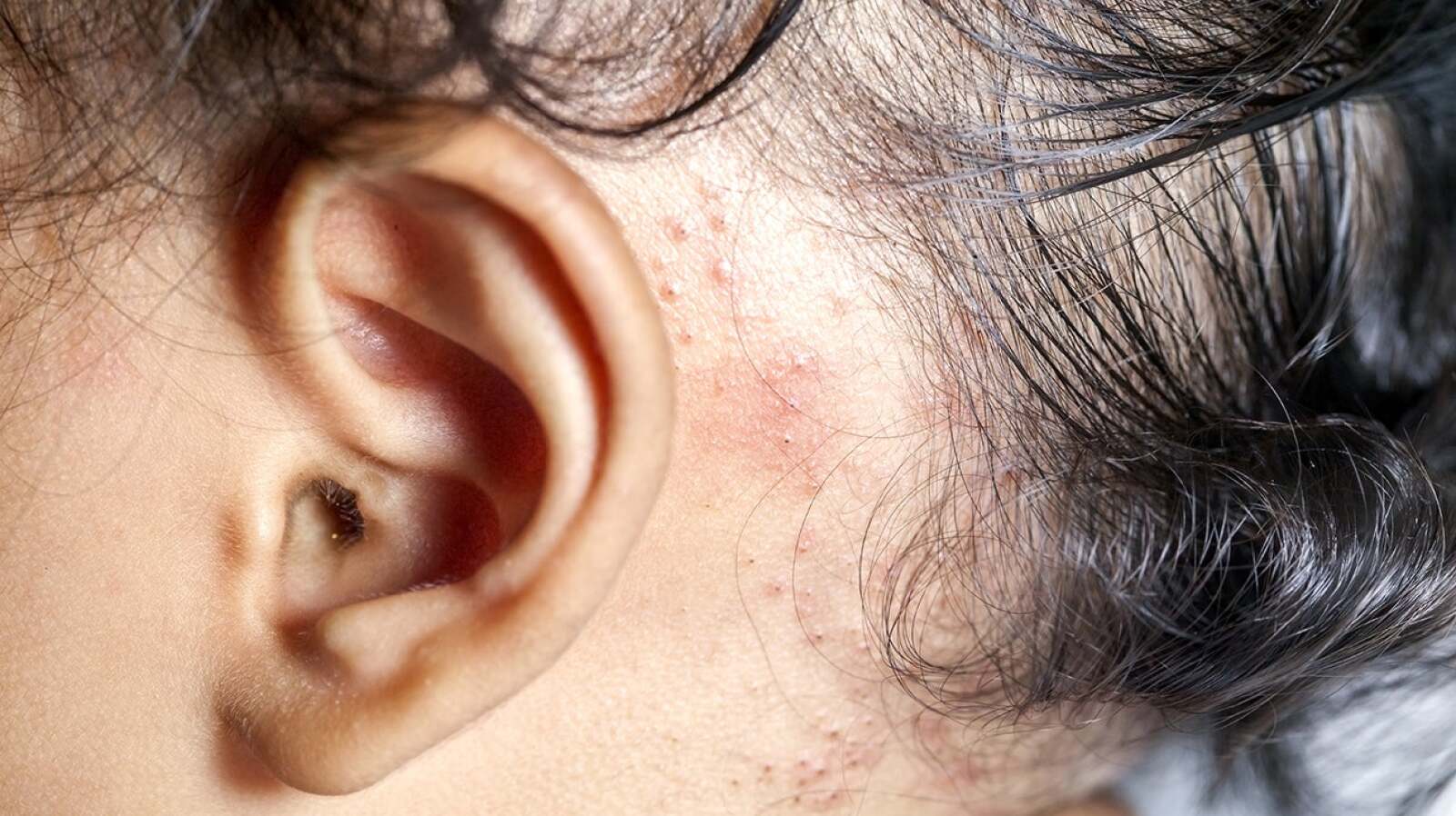 What Does Eczema Look Like? Pictures, Types, and More