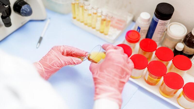 There is a closeup of a person handling a urine sample.
