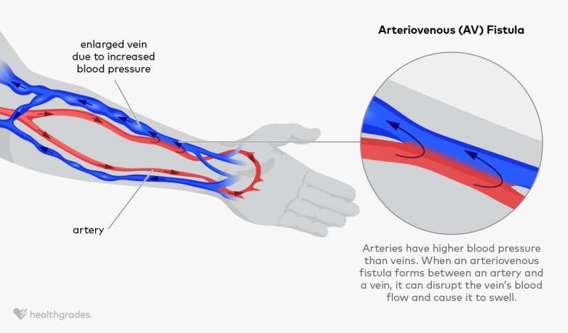 Arteriovenous Fistula: Definition, Symptoms, and Treatments
