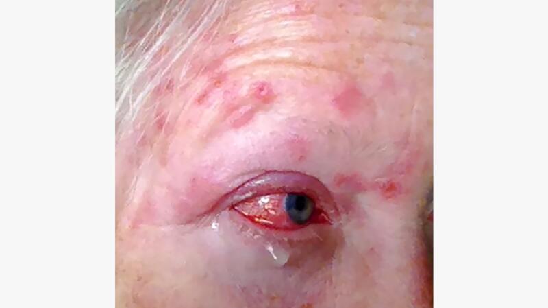 shingles rash on face