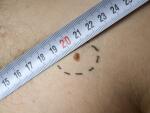 measuring mole, skin mole, skin, mole