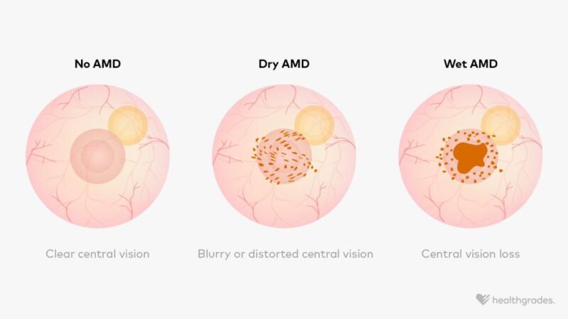 Wet Macular Degeneration: Symptoms, Diagnosis, and Treatments