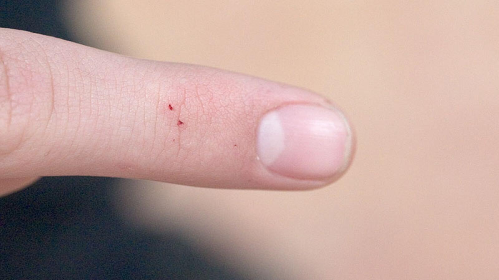Black Widow Bites Identifying Bites, First Aid, Outlook, and More