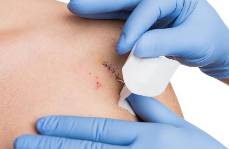 What To Do If A Surgical Wound Reopens Wound Dehiscence