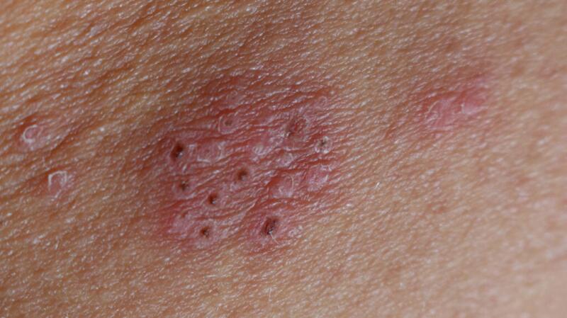 Shingle rash with blisters