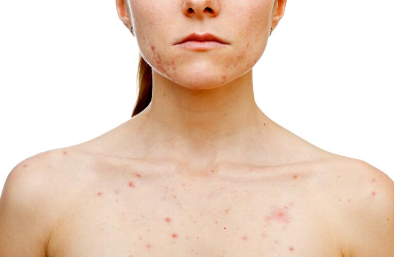 nodular acne vs cystic acne