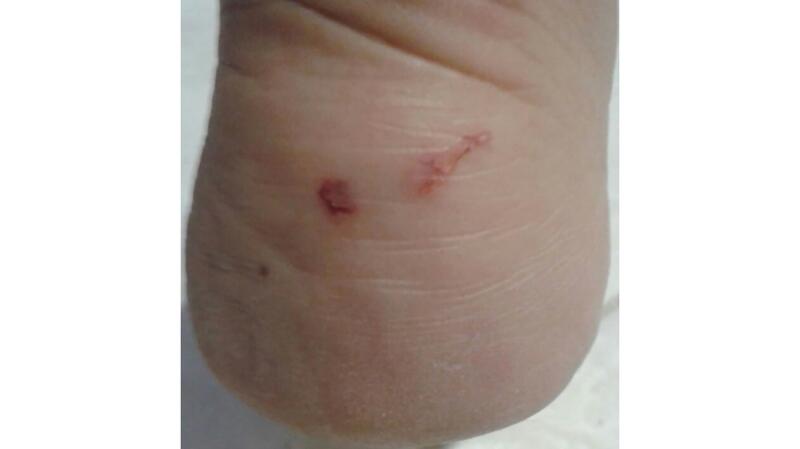 Rat Scratch Rabies What Does A Rat Scratch Look Like – RHPB