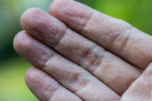 Peeling Fingertips Peeling Fingertips: Possible Causes and Treatments