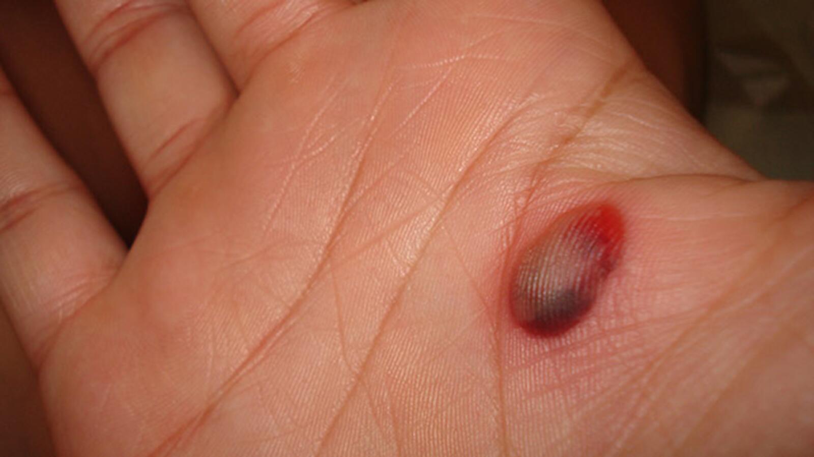 Melanoma Vs Blood Blister Symptoms Causes When To See A Doctor