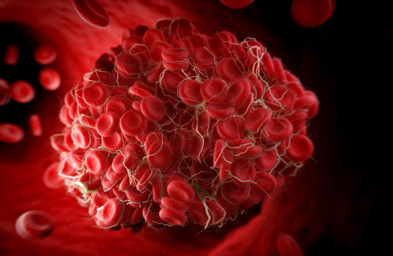Types Of Blood Clots And What They Mean