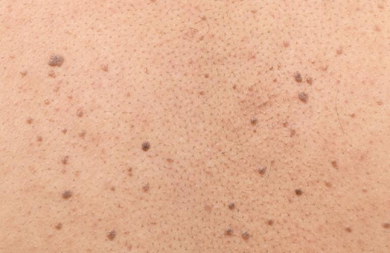 Seborrheic Keratosis: Symptoms, Causes, Treatments - Healthgrades