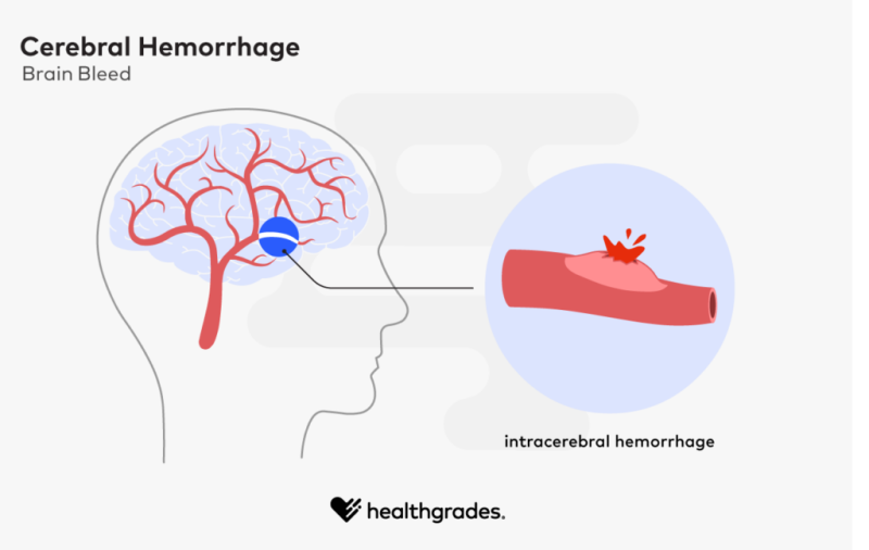 Brain Bleed (Intracranial Hemorrhage): Causes & Symptoms
