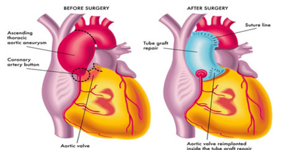 Aortic Aneurysm Surgery and Repair: How It's Done, Risks, What to ...