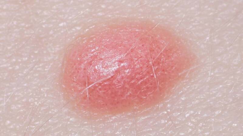 Spitz nevus