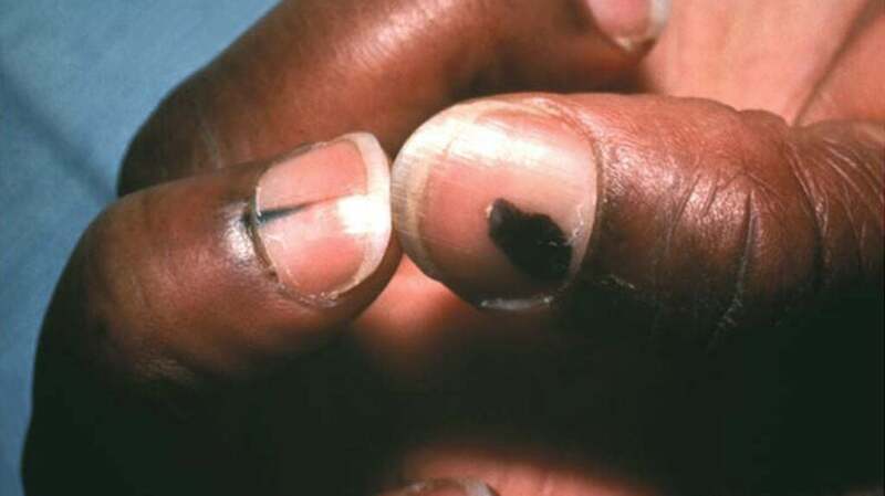 A medical image of acral lentiginous melanoma.